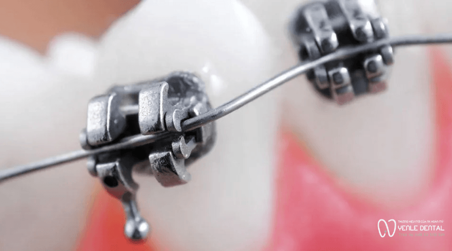 Tuột dây cung khi niềng răng